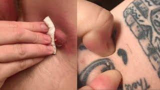 Axillary Abscess, Ear Blackheads and Enormous Zits!  Top 10 Pimple Extractions