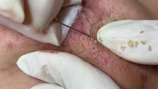 blackhead removal on face satisfying #43 | Top Best Pimple Popping Videos 2019