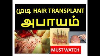 HAIR TRANSPLANT அபாயம் | மரணம் | RISK in HAIR TRANSPLANT | BN Reviews