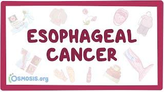 Esophageal cancer - causes, symptoms, diagnosis, treatment, pathology