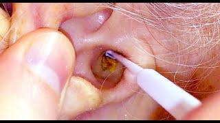 Big Ear Wax Removal!  Extreme Extractions!