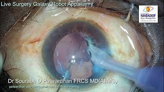 Appasamy Robot Live surgery from Nandadeep Eye Hospital Dr Sourabh Patwardhan