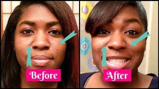 How to Get Rid of Acne Pimples FAST!! [Spot Treatment with Benzoyl Peroxide Results]