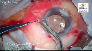 Adherent leukoma morgagnian cataract Live surgery from Nandadeep Eye Hospital Dr Sourabh Patwardhan