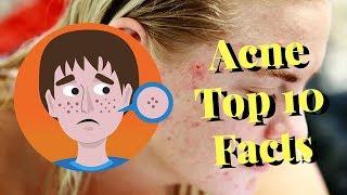 Acne Top 10 Facts