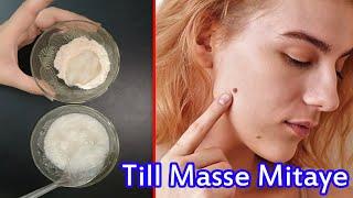 तिल मस्से दाग धब्बे से गायब होंगे जैसे कभी थे ही नही|Remove Skin Tags & Moles Naturally 100% Results