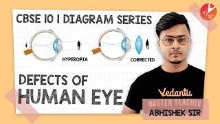 Defects of Human Eye Diagram | Diagram Series | CBSE Class 10 Physics Chapter 11 | Vedantu Class 10