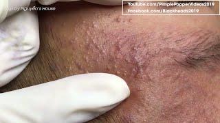 How to removal blackheads on face so relax #31 | Top Best Pimple Popping Videos 2019