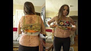 Mom Covered In 6,000 Tumors Looks Drastically Different After Her Surgery