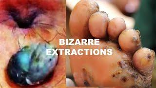 Top 10 Bizarre Extractions of All Time!  Comedones, Pimples and Whiteheads