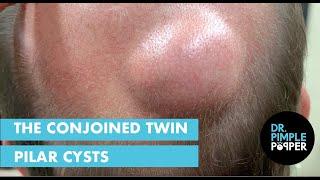 The Conjoined Twin Pilar Cysts
