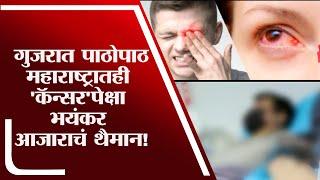 Mucormycosis | गुजरातनंतर महाराष्ट्रातही 'कॅन्सर' पेक्षा भयंकरआजाराचं थैमान! 20 जणांनी गमवले डोळे