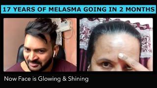 17 years of Melasma is going in 2 months. Now Face is Glowing & Shining #HealthySyrusDiet