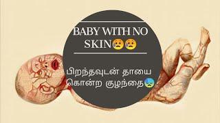 Assam alien baby //baby with no skin//பிறந்தவுடன் தாயைக் கொன்ற குழந்தை 