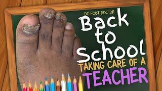 Trimming Fungal Nails & Calluses: Taking Care of a Teacher
