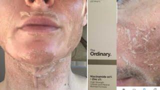 The Ordinary skin care review / Tagalog / top 3 best acne scar treatment/