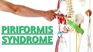 Sciatica Pain May NEVER Improve If You Don't Do 3 Simple Tests For Piriformis Syndrome