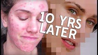 10 YEARS OF ACNE