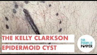 The Kelly Clarkson Epidermoid Cyst