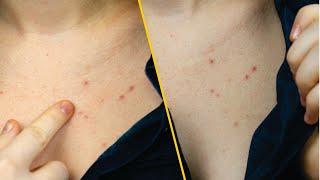 Top Natural Remedies to Get Rid of Chest Acne Fast - Home Remedies Chest Acne Treatment