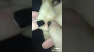 Top 10 people remove pimples In Tik Tok. Part 3