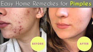 Top 10 home remedies for pimples | Acne Remedies That Actually Work!