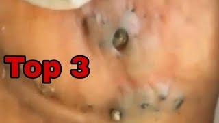 Blackheads Top 3 | Highest in the room | Travis Scott