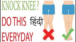 Knock Knee Problem How To Remove And  Top 5 Exercises Hindi