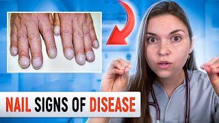 Doctor Explains what your NAILS say about your HEALTH: Top 10 Nail Problems