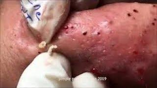 TOP 10 Acne Treatment Whiteheads Blackhead Extraction # 8