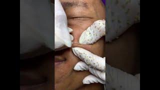 blackhead removal on face satisfying #45 | Top Best Pimple Popping Videos 2019