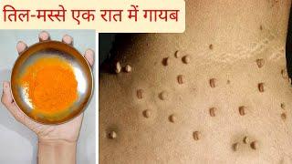 तिल और मस्से को जड़ से ख़त्म करने का सबसे अच्छा उपाय | Remove Moles | Home Remedies Mole |Till-Masse