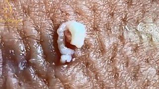 Whiteheads!  Biggest Pimples Popping and Top 10 Comedones!  Zits