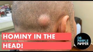 Hominy in the Head! A Pasole Pilar Cyst!