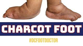 Charcot Foot: A Devastating Condition of Diabetes