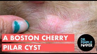 Boston Cherry Pilar Cyst