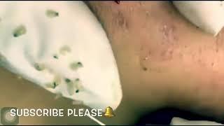 Best Pimple Popping Videos 2019 - 23