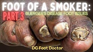 Buerger's Disease, Feet of a Smoker Part 3: Trimming Thick Toenails and Wound Care