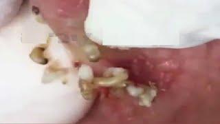 BLACKHEADS REMOVAL #17