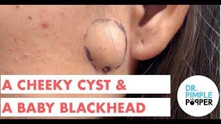 A Cheeky Cyst & A Baby Blackhead