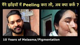 मैंने झाँइयों में Peeling करा ली, अब क्या करूँ ? 10 Years of Melasma/Pigmentation