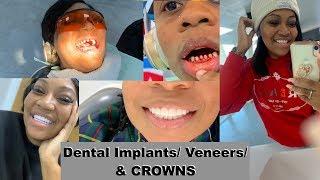 WE HAD OUR TEETH DONE IN TURKEY FOR CHEAP! | THE COST & OUR EXPERIENCE IMPLANTS, CROWNS, & VENEERS