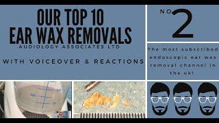 TOP 10 EAR WAX REMOVAL VIDEOS - NUMBER 2