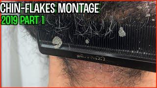 BEARD / CHIN FLAKES MONTAGE 2019 part 1 | DANDRUFF FLAKES | SEBORRHEIC DERMATITIS | PitaFlakes