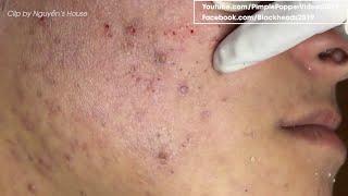 How to removal blackheads on face so relax #34 | Top Best Pimple Popping Videos 2019