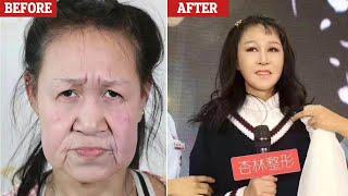 Chinese Girl Xiao Feng, 15, Gets a ‘New Face’ as Her Rare Condition Made Her Look Like a Grandma