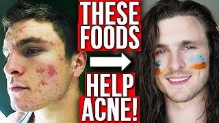 TOP 10 GOOD FOODS FOR ACNE (FROM EXPERIENCE)