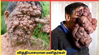 Top 10 வித்தியாசமான மனிதர்கள் | Ten Amazing Peoples With Extraordinary Rare Body Parts | Story Bytes