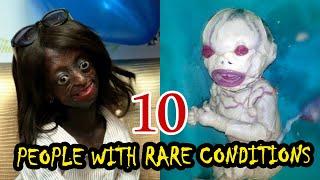 Top 10 People With Rare Medical Conditions