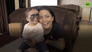 ‘Best Christmas present’: ‘Batman mask’ baby’s mother after challenging operation - INTERVIEW